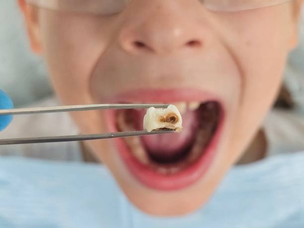 Best Emergency Tooth Extraction in Oberlin, LA